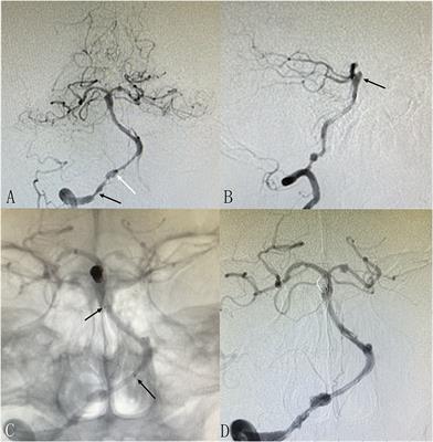 Intervals of endovascular treatment for coincidental non-adjacent unruptured aneurysms in patients with symptomatic intracranial atherosclerotic stenosis